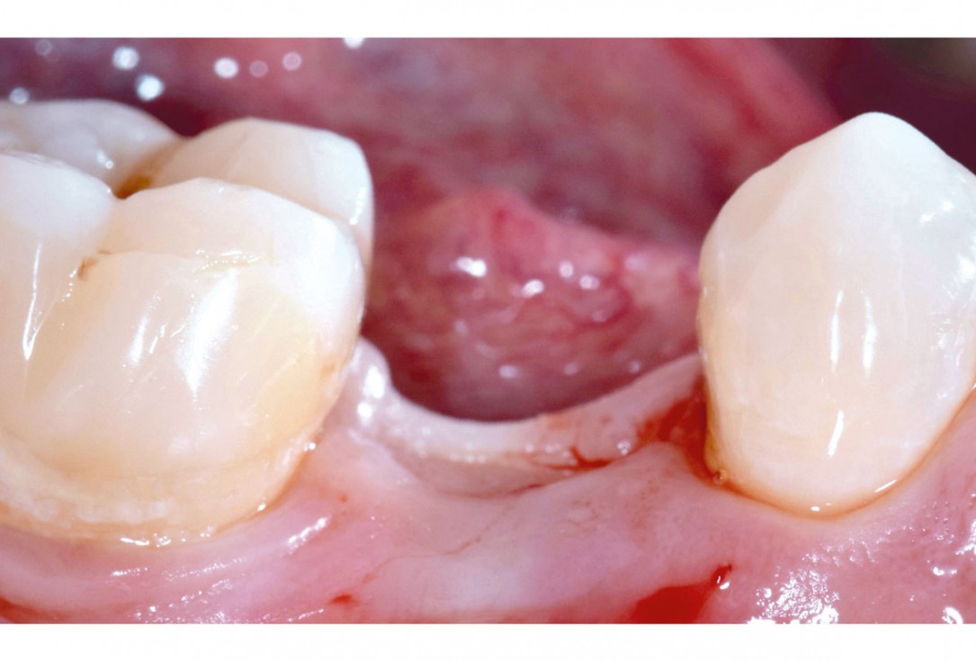 mucoderm® around single implant at second stage surgery