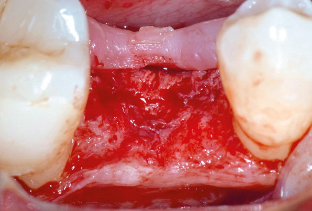 mucoderm® around single implant at second stage surgery