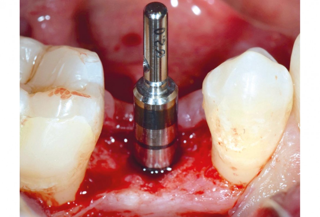 mucoderm® around single implant at second stage surgery