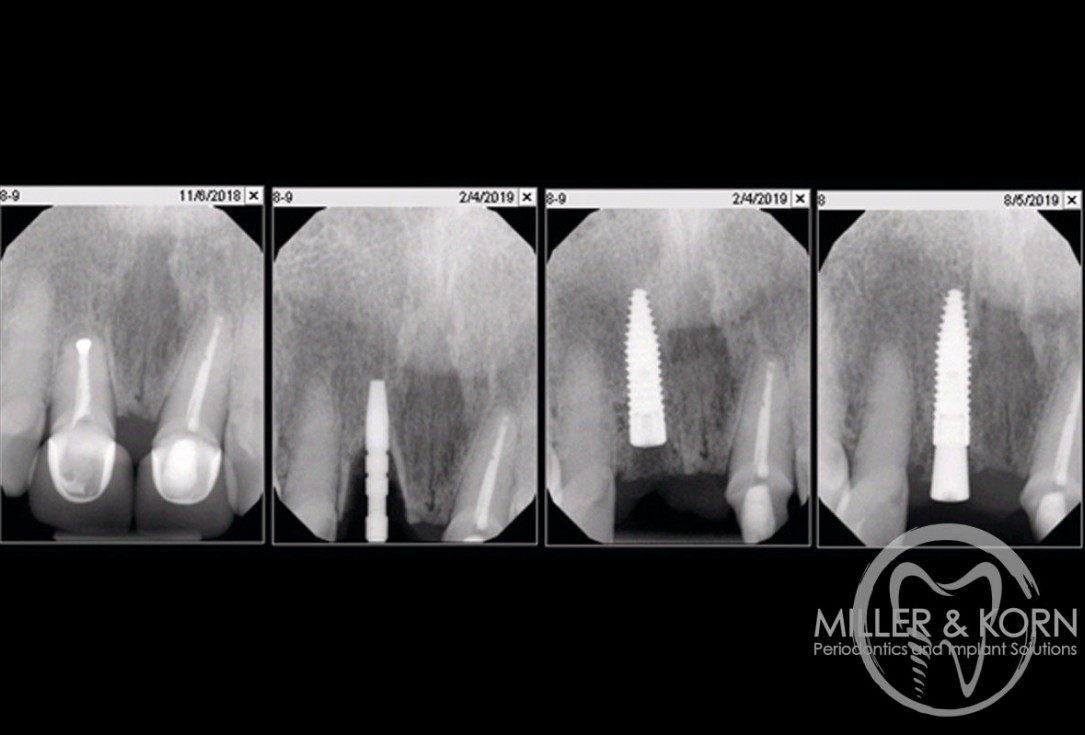 Immediate implant placement and regeneration of ridge using an allograft bone ring and Jason® membrane - Dr. Miller and Korn