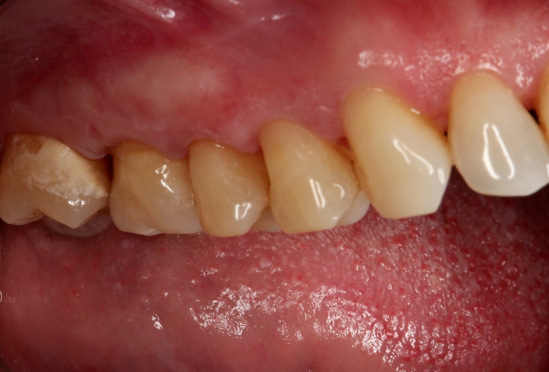 Multiple gingival recessions treated by MCAT with mucoderm® and Straumann® Emdogain® (2) - Rathe 