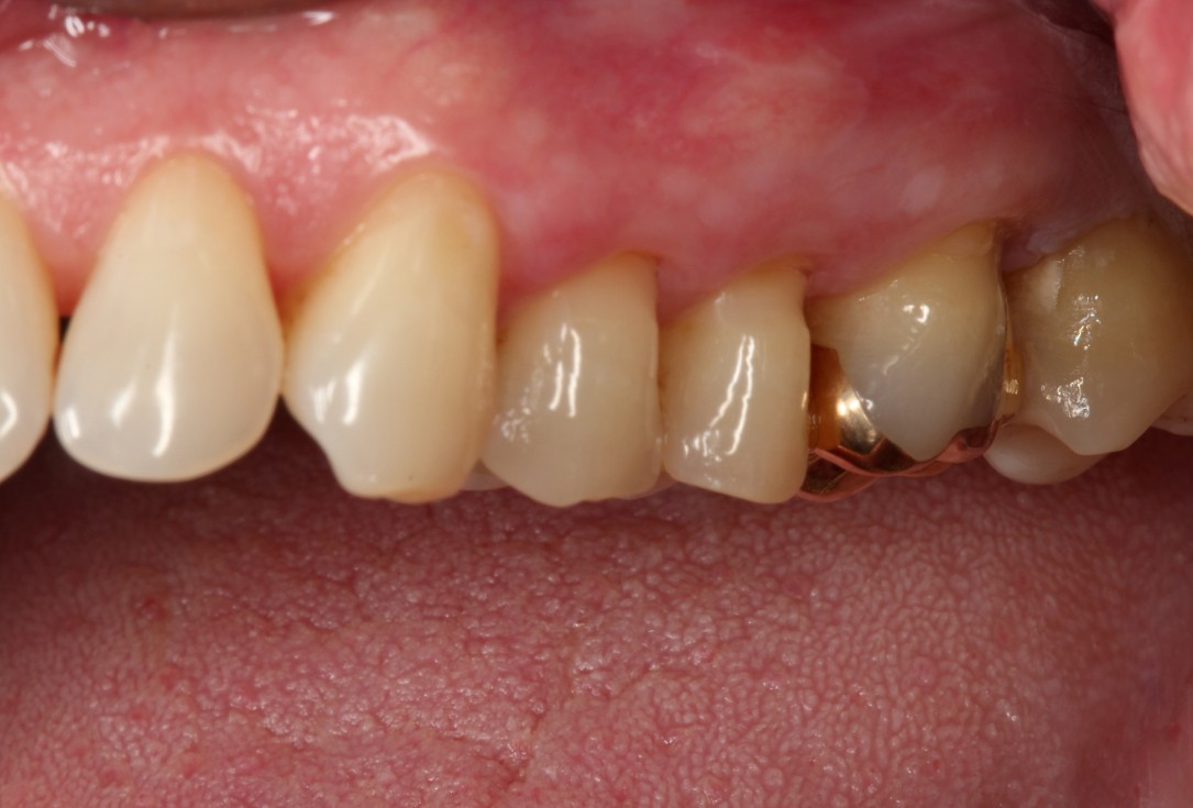 Multiple gingival recessions treated by MCAT with mucoderm® and Straumann® Emdogain® (2) - Rathe