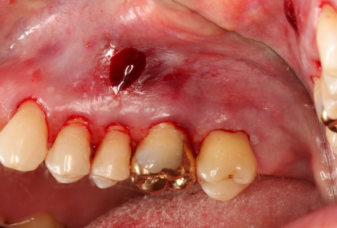 Multiple gingival recessions treated by MCAT with mucoderm® and Straumann® Emdogain® (2) - Rathe