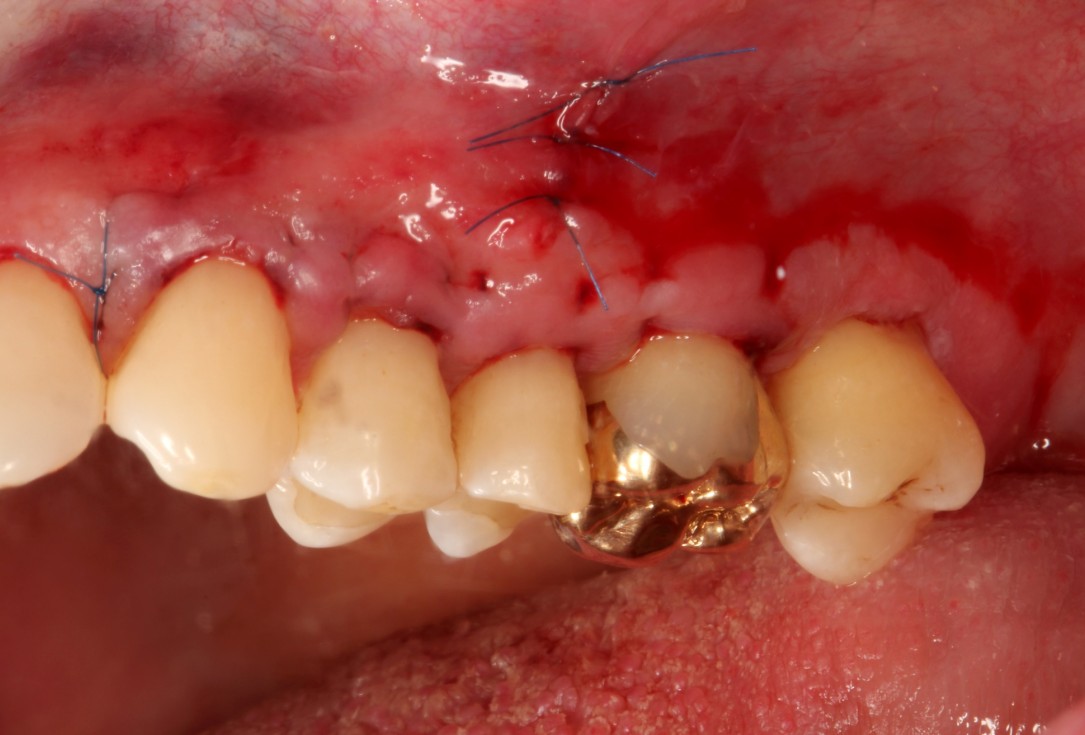Multiple gingival recessions treated by MCAT with mucoderm® and Straumann® Emdogain® (2) - Rathe