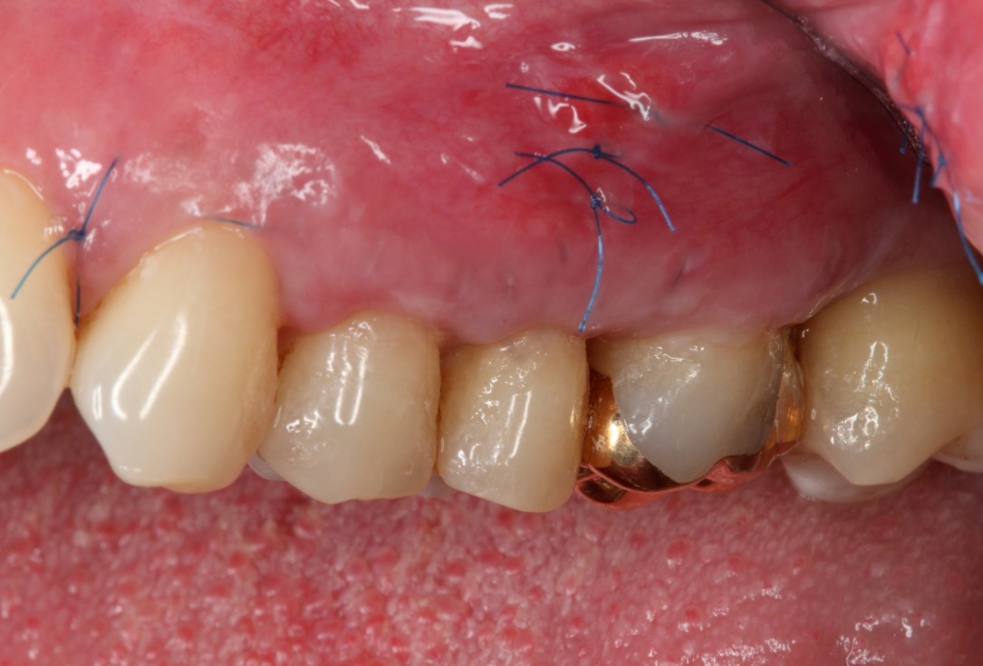 Multiple gingival recessions treated by MCAT with mucoderm® and Straumann® Emdogain® (2) - Rathe