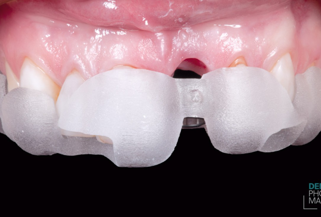 Guided bone ring procedure in aesthetic zone - Dr. K. Chmielewski & Dr. O. Yüksel