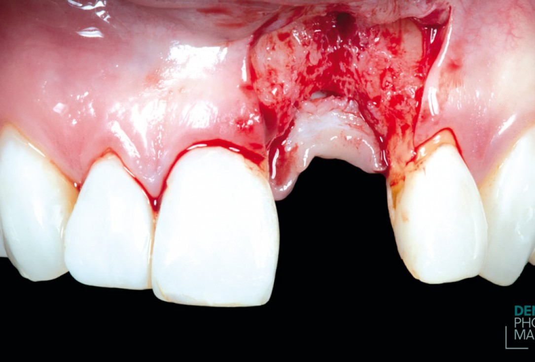 Guided bone ring procedure in aesthetic zone - Dr. K. Chmielewski & Dr. O. Yüksel