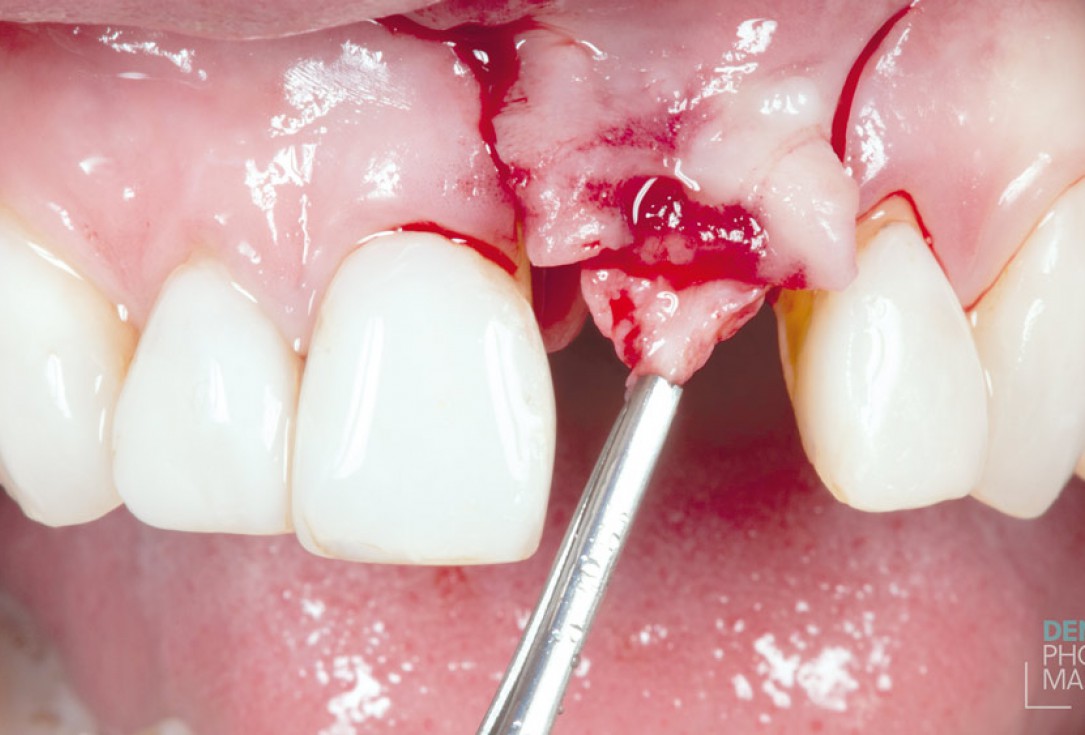 Guided bone ring procedure in aesthetic zone - Dr. K. Chmielewski & Dr. O. Yüksel