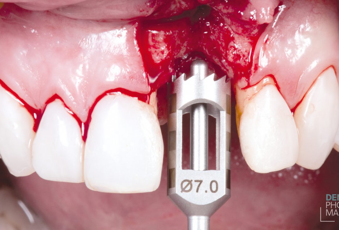 Guided bone ring procedure in aesthetic zone - Dr. K. Chmielewski & Dr. O. Yüksel