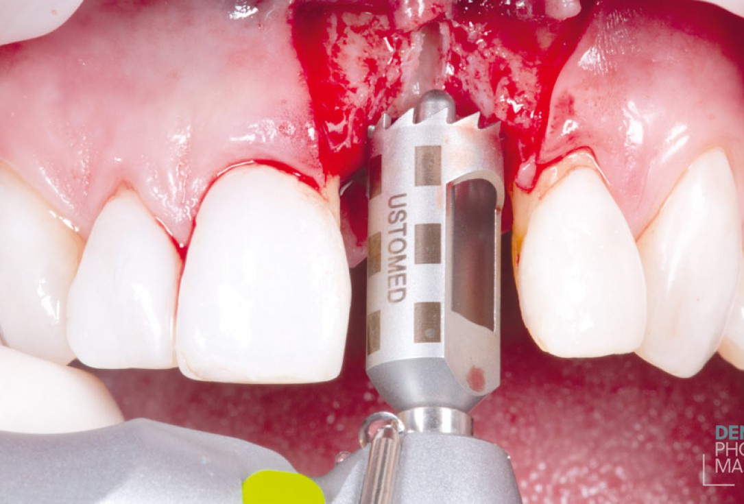 Guided bone ring procedure in aesthetic zone - Dr. K. Chmielewski & Dr. O. Yüksel