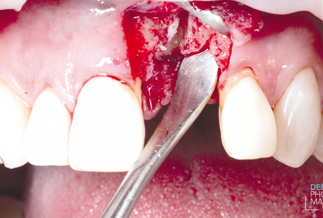 Guided bone ring procedure in aesthetic zone - Dr. K. Chmielewski & Dr. O. Yüksel