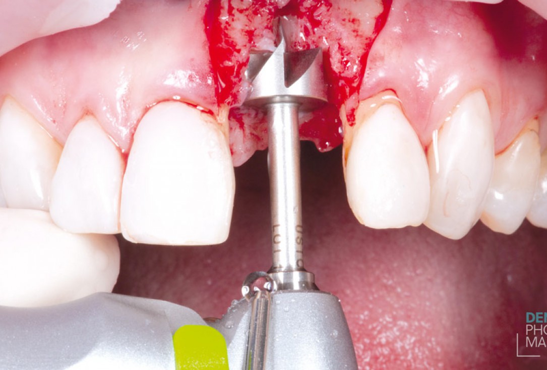 Guided bone ring procedure in aesthetic zone - Dr. K. Chmielewski & Dr. O. Yüksel