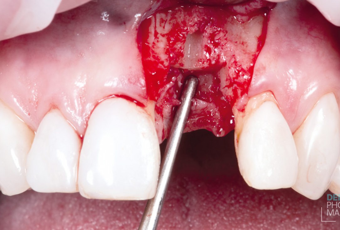 Guided bone ring procedure in aesthetic zone - Dr. K. Chmielewski & Dr. O. Yüksel