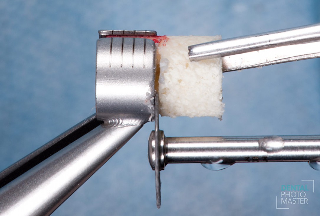 Guided bone ring procedure in aesthetic zone - Dr. K. Chmielewski & Dr. O. Yüksel