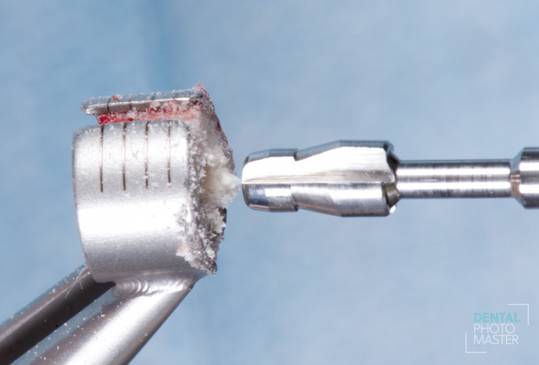 Guided bone ring procedure in aesthetic zone - Dr. K. Chmielewski & Dr. O. Yüksel