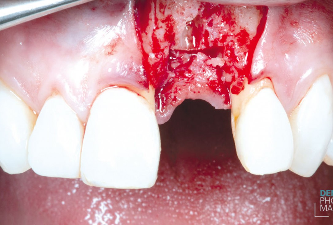 Guided bone ring procedure in aesthetic zone - Dr. K. Chmielewski & Dr. O. Yüksel