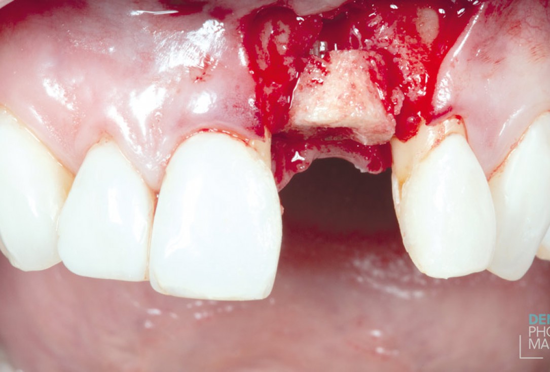 Guided bone ring procedure in aesthetic zone - Dr. K. Chmielewski & Dr. O. Yüksel