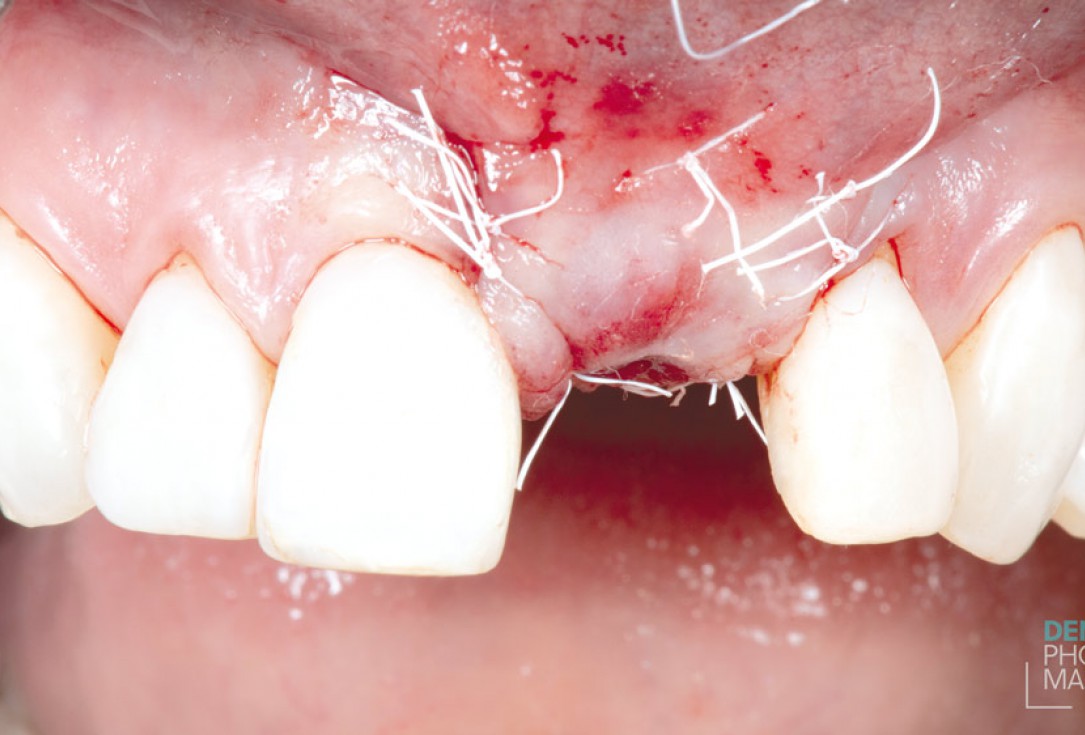 Guided bone ring procedure in aesthetic zone - Dr. K. Chmielewski & Dr. O. Yüksel