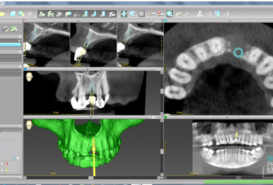 Guided bone ring procedure in aesthetic zone - Dr. K. Chmielewski & Dr. O. Yükse