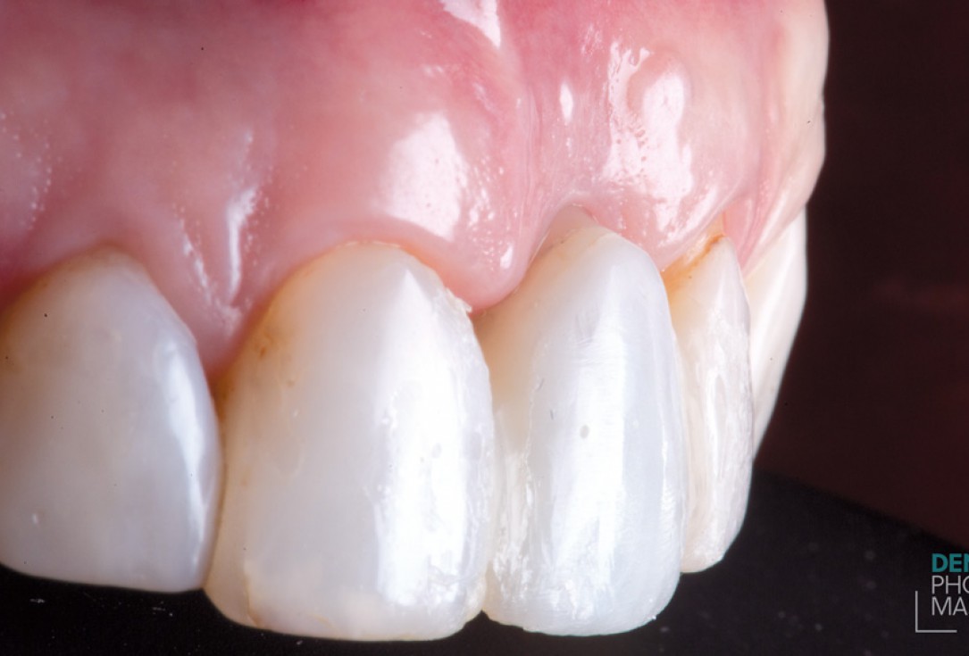 Guided bone ring procedure in aesthetic zone - Dr. K. Chmielewski & Dr. O. Yükse