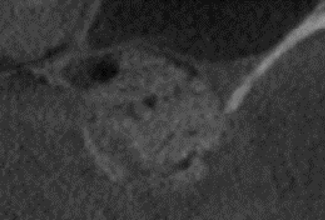 Two-stage sinus lift with maxresorb® and collprotect® - Dr. Steffen Kistler