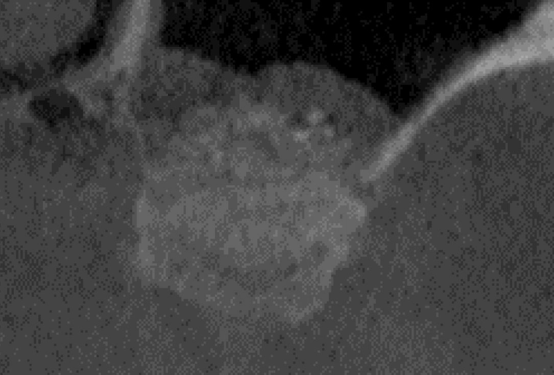 Two-stage sinus lift with maxresorb® and collprotect® - Dr. Steffen Kistler