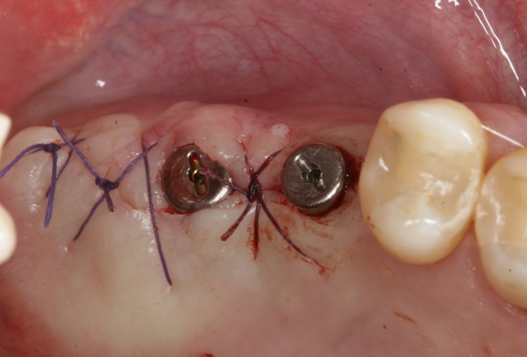Two-stage sinus lift with maxresorb® and collprotect® - Dr. Steffen Kistler