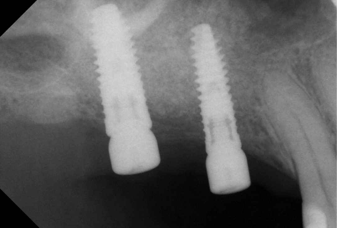 Two-stage sinus lift with maxresorb® and collprotect® - Dr. Steffen Kistler