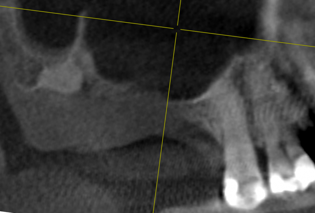 Two-stage sinus lift with maxresorb® and collprotect® - Dr. Steffen Kistler