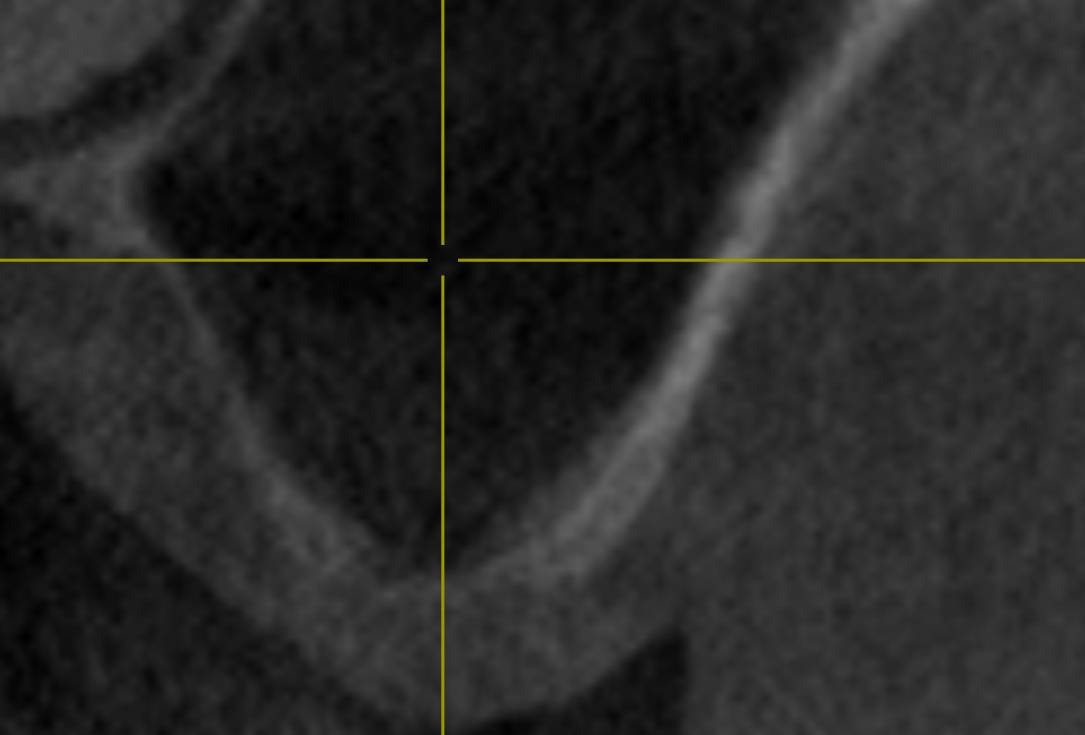 Two-stage sinus lift with maxresorb® and collprotect® - Dr. Steffen Kistler