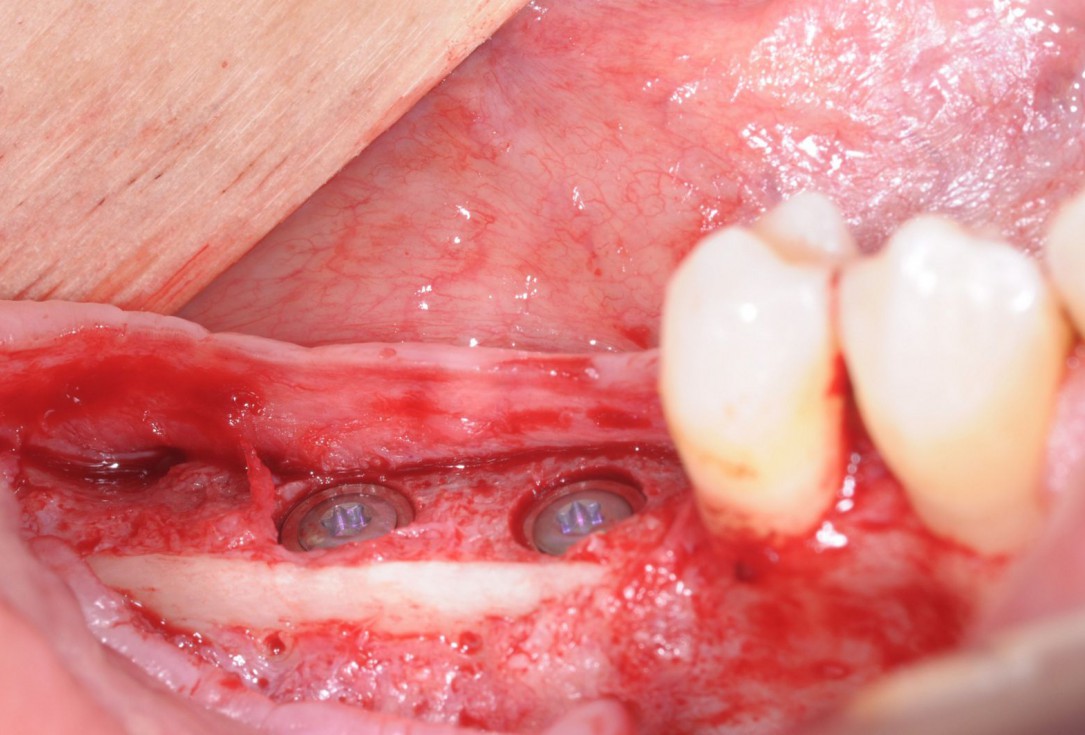 Three-dimensional augmentation with maxgraft® cortico - Dr. R. Würdinger