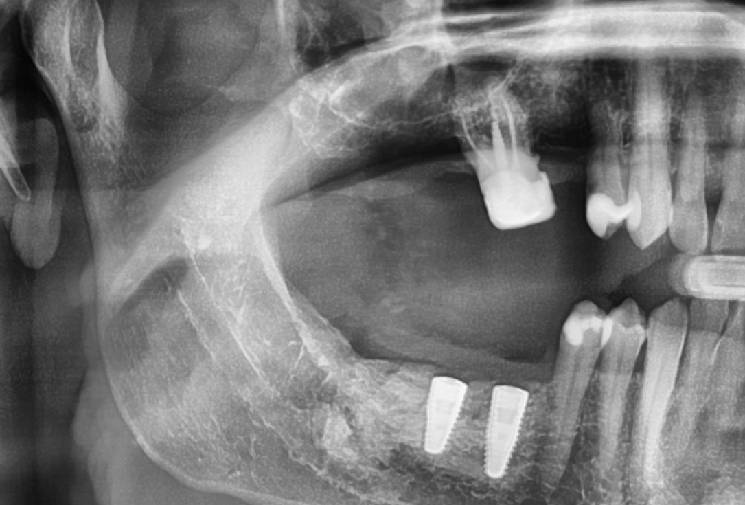 Three-dimensional augmentation with maxgraft® cortico - Dr. R. Würdinger