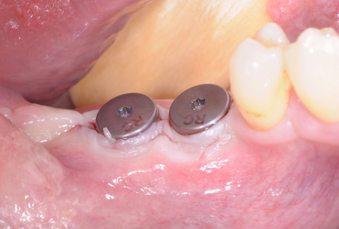 Three-dimensional augmentation with maxgraft® cortico - Dr. R. Würdinger