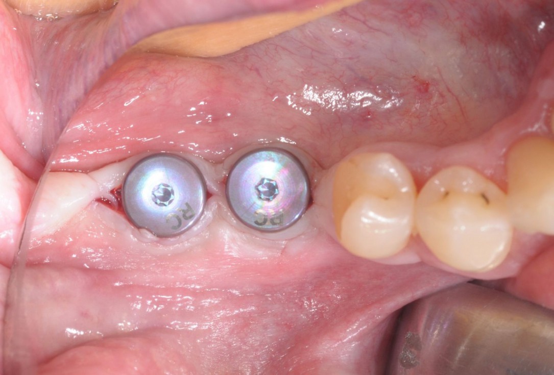 Three-dimensional augmentation with maxgraft® cortico - Dr. R. Würdinger