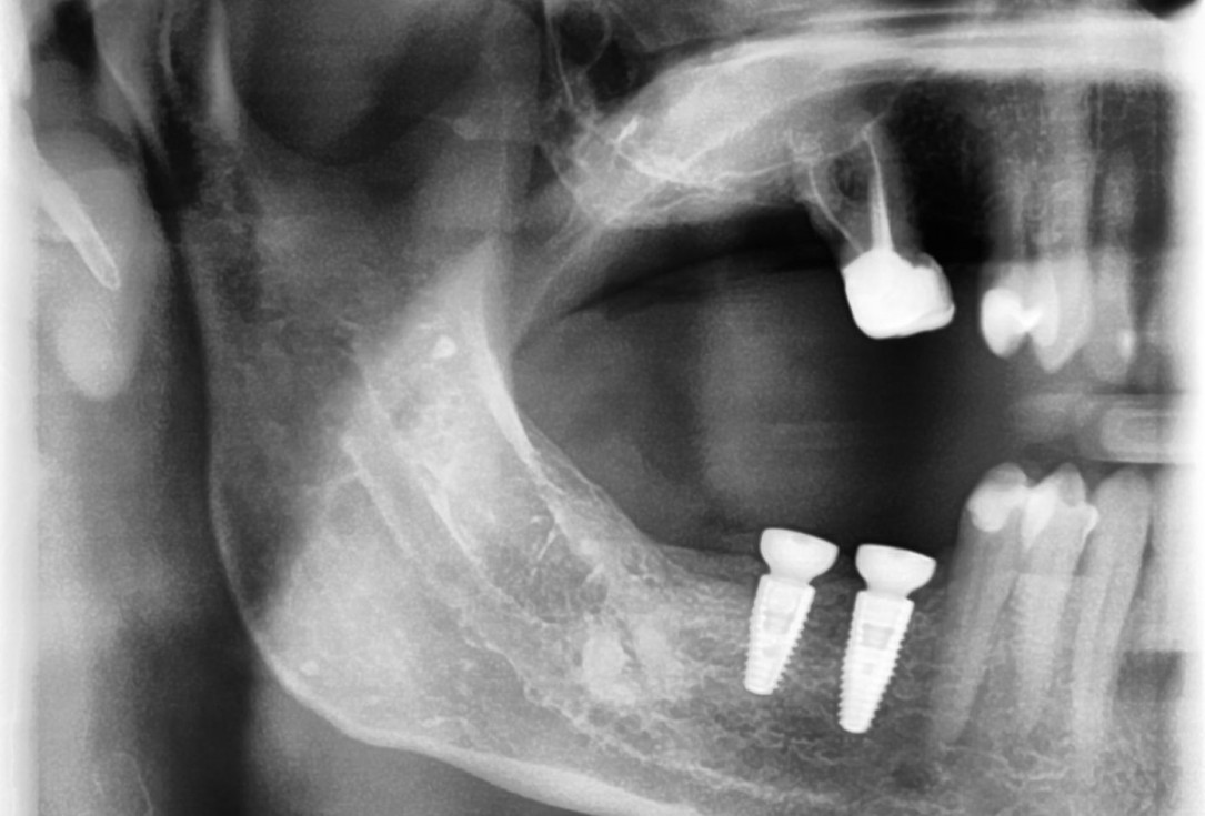 Three-dimensional augmentation with maxgraft® cortico - Dr. R. Würdinger