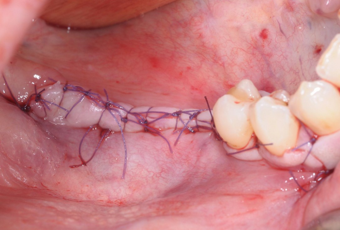 Three-dimensional augmentation with maxgraft® cortico - Dr. R. Würdinger