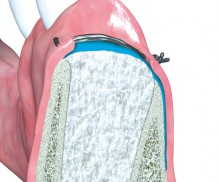 Eine dPTFE Membran deckt das Augmentat und den Knochenwanddefekt ab und bleibt exponiert zur offenen Einheilung. Ridge Preservation mit einer dPTFE Membran
