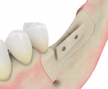 Schalentechnik - maxgraft® cortico