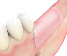 Schalentechnik - maxgraft® cortico