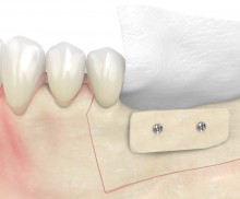 Schalentechnik - maxgraft® cortico