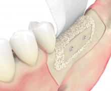 Schalentechnik - maxgraft® cortico